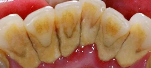 沖牙器有害論？破除2019年口腔衛生用品的誤區